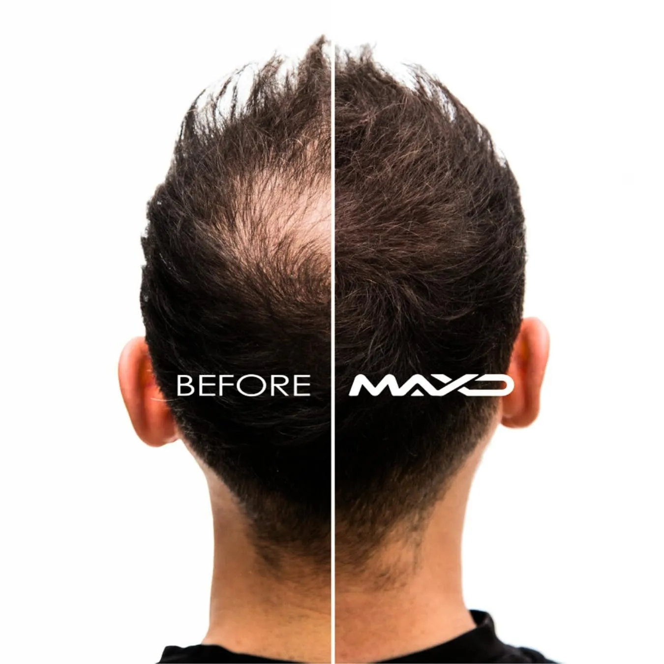 Premium Hair Thinning Concealment Kit - Includes Hair Building Fibers, Fiber Hold Spray, Applicator & Hairline Optimizer – Conceals Thinning Hair for Men & Women - Provides a Natural Look (Dark Brown)